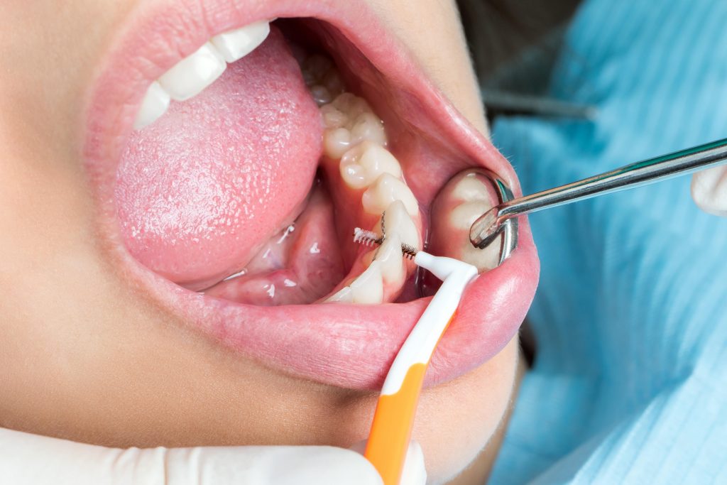 fogínygyullaadás kezelése fogorvos fogászat